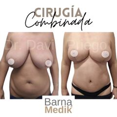 Lipoescultura - Clínica BarnaMedik