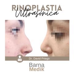 Rinoplastia - Clínica BarnaMedik