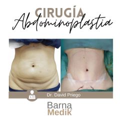 Abdominoplastia - Clínica BarnaMedik