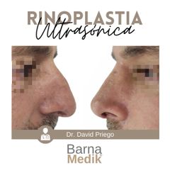 Rinoplastia - Clínica BarnaMedik