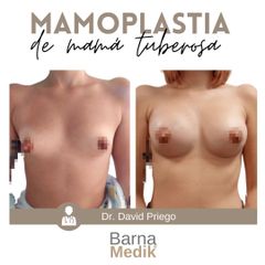 Aumento de pecho - Clínica BarnaMedik
