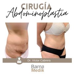 Abdominoplastia - Clínica BarnaMedik