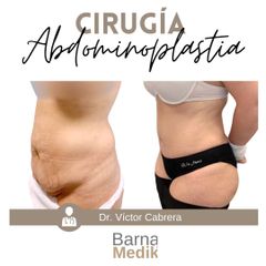 Abdominoplastia - Clínica BarnaMedik