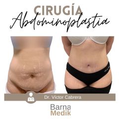 Abdominoplastia - Clínica BarnaMedik
