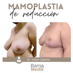 Reducción de senos - Clínica BarnaMedik
