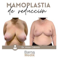 Reducción de senos - Clínica BarnaMedik