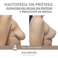 Mastopexia - Clínica BarnaMedik