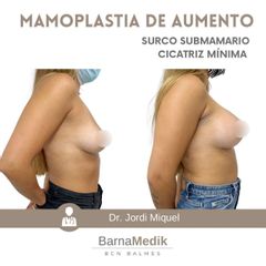 Aumento de pecho - Clínica BarnaMedik