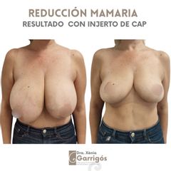 Reducción senos - Clínica BarnaMedik