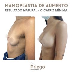 Aumento de pecho - Clínica BarnaMedik