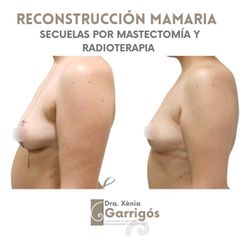 Reconstrucción mamaria - Clínica BarnaMedik