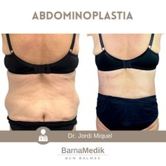 Abdominoplastia - Clínica BarnaMedik