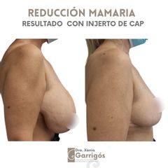 Reducción senos - Clínica BarnaMedik