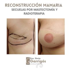 Reconstrucción mamaria - Clínica BarnaMedik