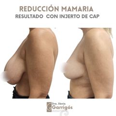 Reducción senos - Clínica BarnaMedik