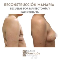 Reconstrucción mamaria - Clínica BarnaMedik