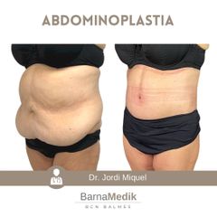Abdominoplastia - Clínica BarnaMedik