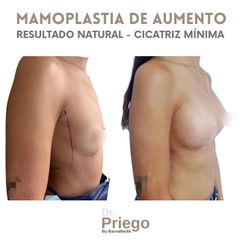 Aumento de pecho - Clínica BarnaMedik