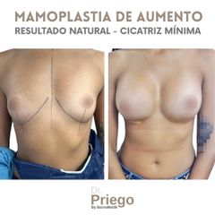 Aumento de pecho - Clínica BarnaMedik
