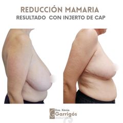 Reducción senos - Clínica BarnaMedik