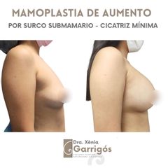 Aumento de pecho - Clínica BarnaMedik