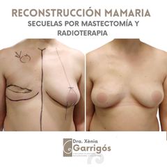 Reconstrucción mamaria - Clínica BarnaMedik