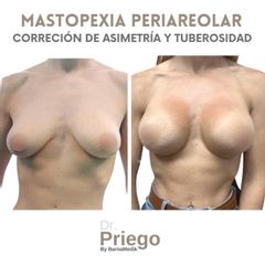 Mastopexia - Clínica BarnaMedik