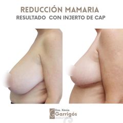 Reducción senos - Clínica BarnaMedik