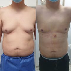 Liposucción - Clinica Adcure