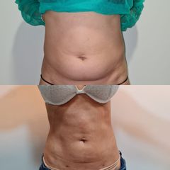 Liposucción - Clinica Adcure