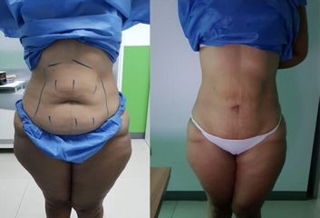 Liposucción - Clinica Adcure