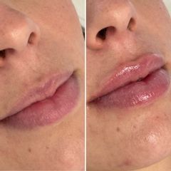 Aumento de labios - Clinica Adcure
