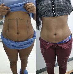 Liposucción - Clinica Adcure