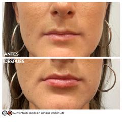 Antes y después Aumento de labios - Clínicas Doctor Life