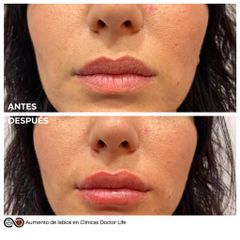 Antes y después Aumento de labios - Clínicas Doctor Life