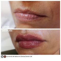Aumento de labios - Clínicas Doctor Life