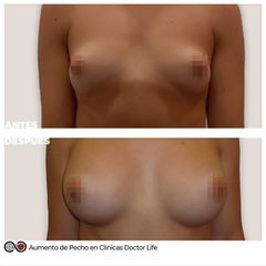 Aumento de pecho - Clínicas Doctor Life