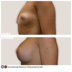 Aumento de pecho - Clínicas Doctor Life