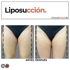Liposucción - Clínicas Doctor Life