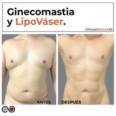 Ginecomastia + Lipo Vaser - Clínicas Doctor Life