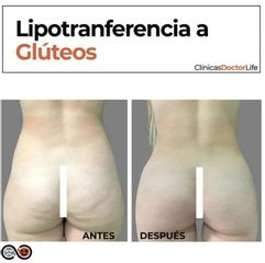 Lipotransferencia glútea - Clínicas Doctor Life