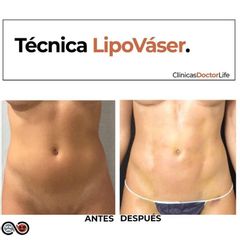 Lipo Vaser - Clínicas Doctor Life