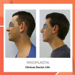 Rinoplastia - Clínicas Doctor Life