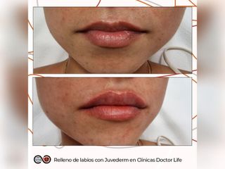 Clínicas Doctor Life - Relleno de labios