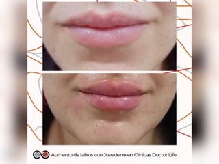 Clínicas Doctor Life - Aumento de labios