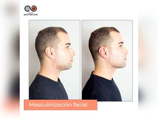 Clínicas Doctor Life - Masculinización Facial