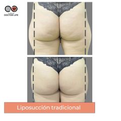 Liposucción - Clínicas Doctor Life