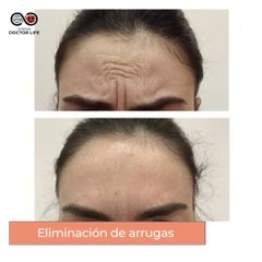 Rellenos faciales - Clínicas Doctor Life