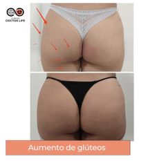 Aumento de glúteos - Clínicas Doctor Life