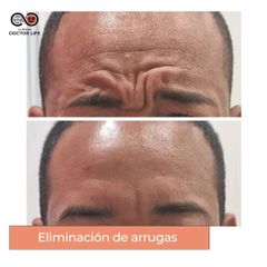 Eliminación de arrugas - Clínicas Doctor Life